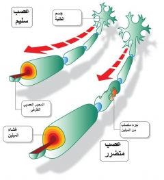 صورة العصب التالف لمرض التصلب العصبى